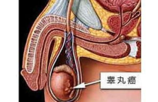 睾丸癌,病因、症状、诊断与治疗全解析